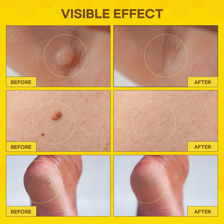 Fast-Acting Bee Venom Wart Remover: Wart Freeze off with Salicylic Acid & Bee Venom Cream - Wart Removal for Plantar Wart Genital Wart Common Wart on Face Hand Finger 30