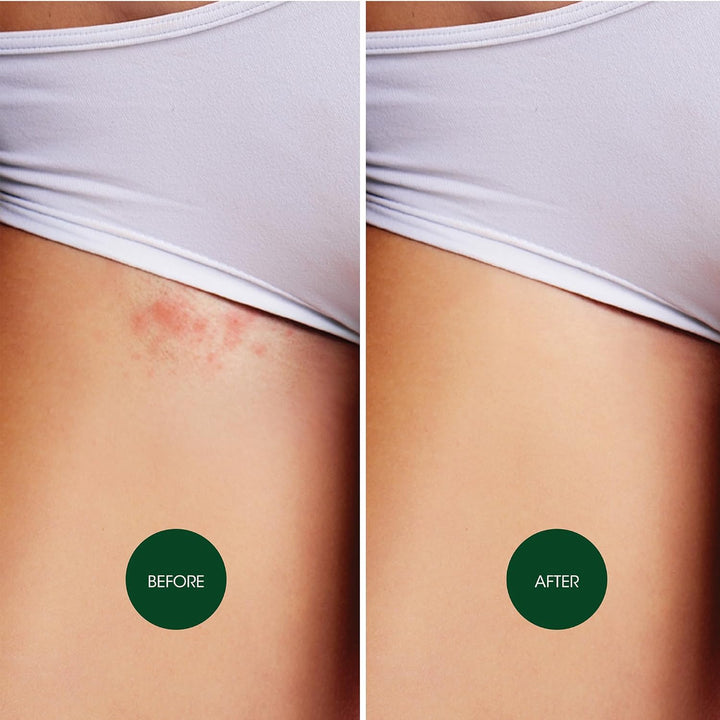 Soothing Ingrow Solution, Ingrown Hair Reduction, Treatment for Ingrown Hairs, Redness and Inflammation, Ingrown Hair Treatment, 125Ml