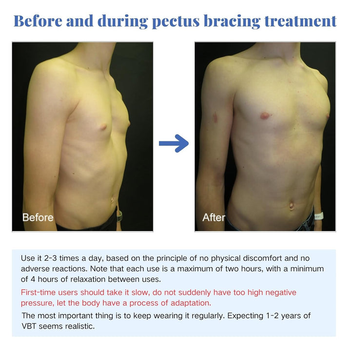 Pectus Excavatum Orthosis Brace, Pectus Excavatum Vacuum Bell with Pressure Gauge, Sternal Depression Support for Sunken Chest, Physical Chest Correction for All Ages (L)