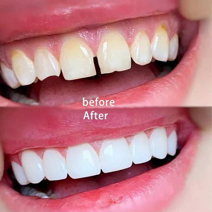 Temporary Tooth Repair Kit Fix Broken Teeth Dental Repair Kit Tooth Bead Tooth Filling Replacement False Teeth Adhesive Thermal Fitting Beads Tooth Veneer for Missing Cracked Chipped Chipped Tooth
