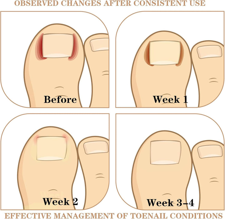 60Pcs Ingrown Toenail Treatment Patches-Ingrown Toenail Corrector Strips, Durable Toe Spacers, Quick Repair Ingrown Nail Tool for Women Men