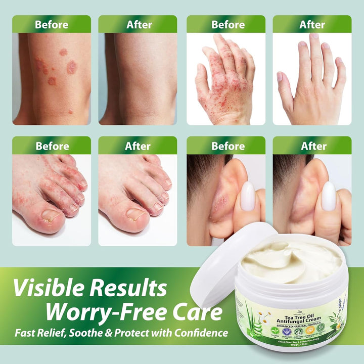 Tea Tree Oil Antifungal Cream: Natural Treatment for Athlete'S Foot, Jock Itch, Ringworm, Eczema, and Tinea Versicolor, Soothing & Hydrating Formula, 100G