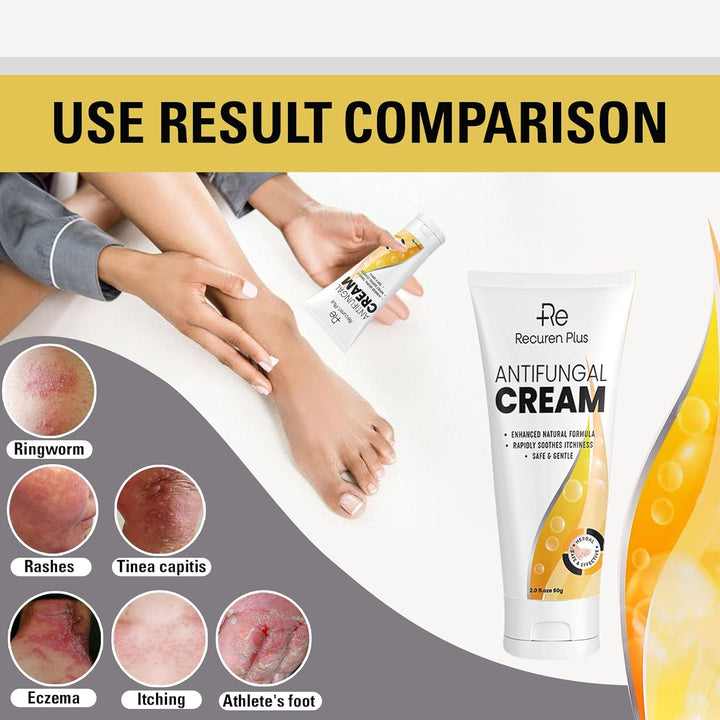 Antifungal Herbal Skin Care Cream: Daily Comfort for Athlete’S Foot, Jock Itch & Ringworm – Gentle, Nourishing and Hydrating 60G