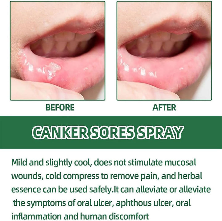 Mouth Ulcer Treatment Spray,Mouth Ulcer Treatment for Adults,Canker Sore Relief Treatment,Herbal Mouths Sprays for Ulcer Treatments,Dry Mouth Relief,Breath Freshener Spray(Pack of 1)