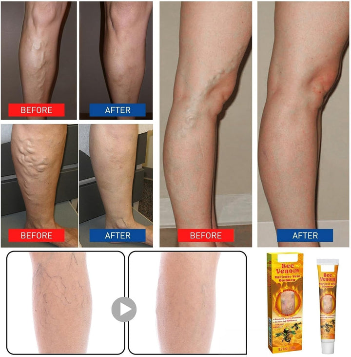 Varic/Ose Ve/Ins Treatment for Legs,Natural Varic/Ose Ve/Ins Cream,Varic/Ose Ve/Ins Treatment Cream,Cream for Varic/Ose Ve/Ins in Legs,Spi/Der V/Eins Repair Cream,Varic/Ose Ve/Ins Relief Cream