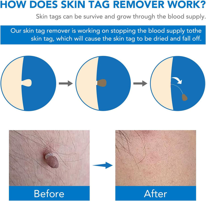 Skin Tag Remover, Skin Tags & Moles Remover Kit, Skin Mole Tag Remover Set Easy Remove Small to Large (2Mm-8Mm)
