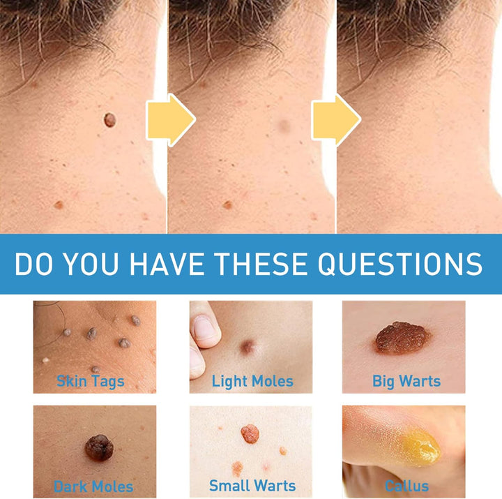 Wart Remover Cream for Body and Hands, Suitable for Common Warts, Flat Warts - 20G (1)