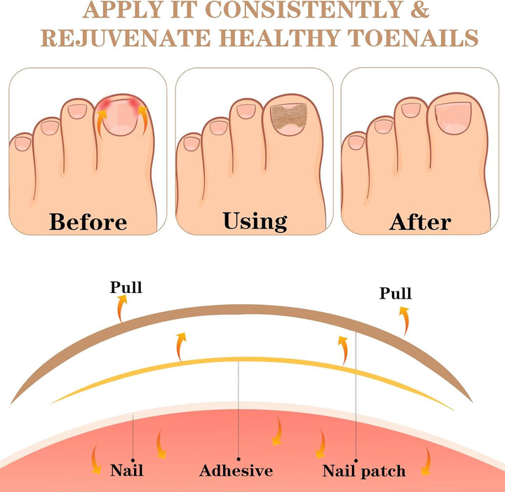 60Pcs Ingrown Toenail Treatment Patches-Ingrown Toenail Corrector Strips, Durable Toe Spacers, Quick Repair Ingrown Nail Tool for Women Men