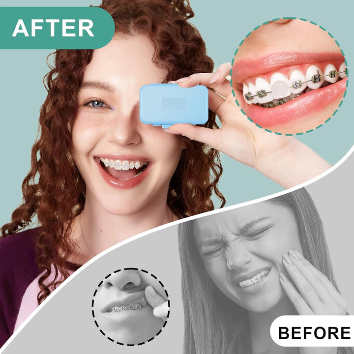 10 Boxes Dental Wax for Braces, Dental Orthodontic, Braces Wax with Fruit Smell, Dental Oral Care, Silicone Orthodontic, Wearers Gum Protection, Tooth (10 Scent)