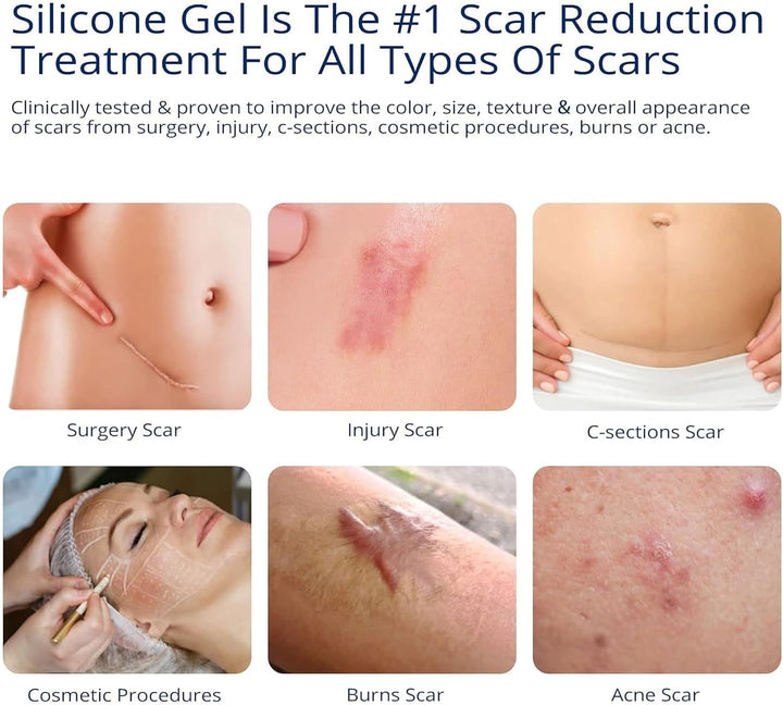 Silicone Scar Gel 30G Scar Cream,Scar Removal,Scar Treatment, Scar Removal Cream for C-Section, Stretch Marks, Acne, Surgery, Effective for Both Old and New Scars