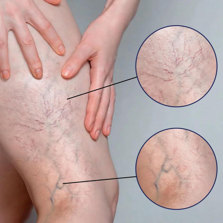 Varic/Ose Ve/Ins Treatment for Legs,Natural Varic/Ose Ve/Ins Cream,Varic/Ose Ve/Ins Treatment Cream,Cream for Varic/Ose Ve/Ins in Legs,Spi/Der V/Eins Repair Cream,Varic/Ose Ve/Ins Relief Cream