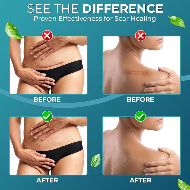 Medical Grade Silicone Scar Tape | 4Cm X 1.2M | Silicone Scar Sheets for after Surgery C Section Recovery, Wrinkles Removal, Face Treatment Gel Patches/Plasters