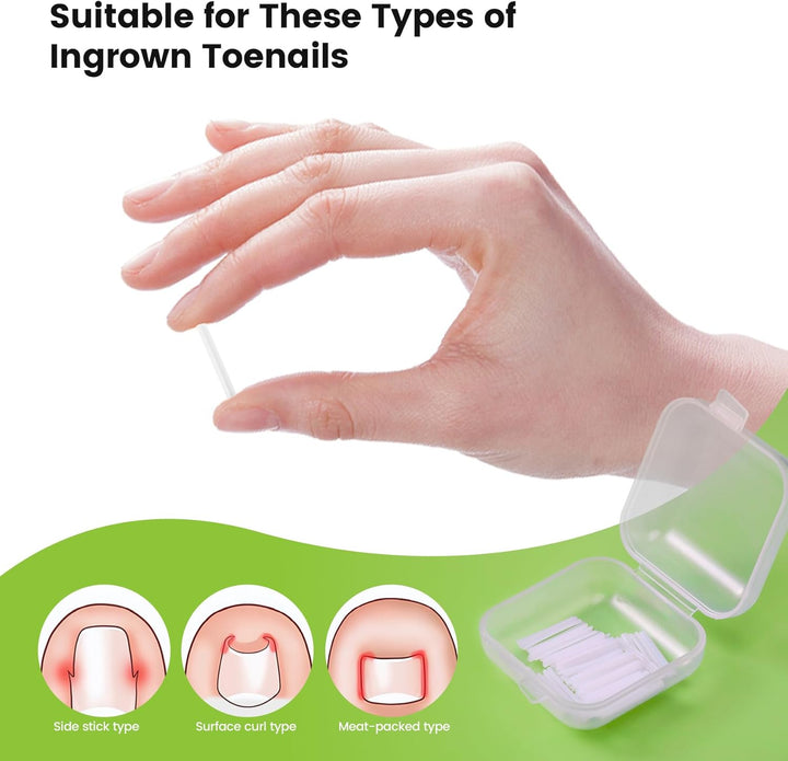 Ingrown Toenail Corrector Set - 40 Pcs Pain-Free Toenail Straightener Strips with Toenail Lifter - Easy Use Ingrown Toenail Tools Kit