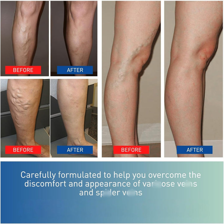 Bee Venom Varicos/E Ve/Ins Treatment for Legs,Varico/Se Relief Vein/S Cream,Varicos/E Vein/S Treatment Cream,Spider Vei/Ns Repair Crea/M,Tired and Heavy Legs Relief,Non-Greasy,Fast-Absorbing