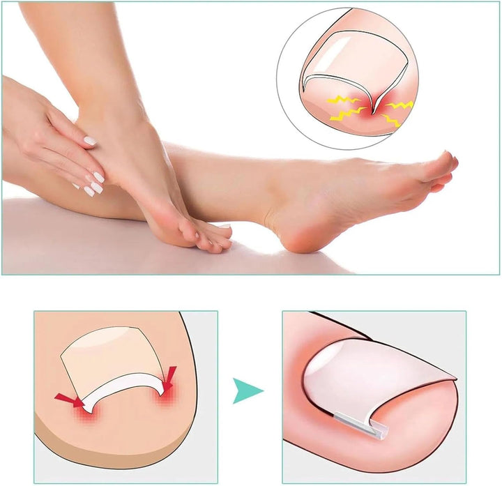 (50+1) Pcs Ingrown Toenail Tool Kit - Corrector with Lifter & Straightener Strips, Pain-Free Treatment for In-Grown Toe Nails, Easy Fixed Toenail Correction Tool.