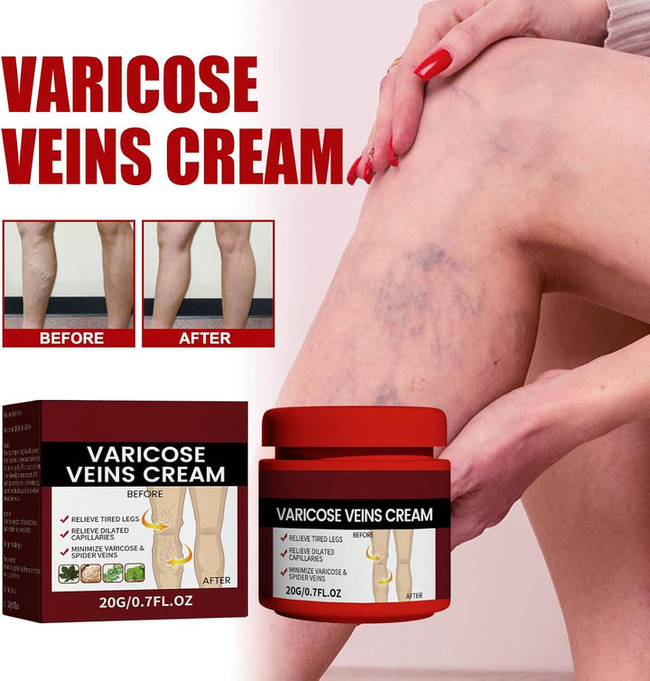 Cream for Varicose Veins in Legs,Varicose Veins Cream,Vein Relief Cream,Vein Cream for Legs,Varicose Veins Treatment Cream,Varicose Vein Removal Cream,Improve Blood Circulation,20G,1Pc