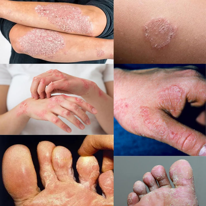 Zulona Cream – Luliconazole 1% Antifungal Treatment for Ringworm, Athlete'S Foot & Jock Itch – Relief Whithin 24Hr from Itching, Redness & Fungal Infections – Topical Azole Class Cream.