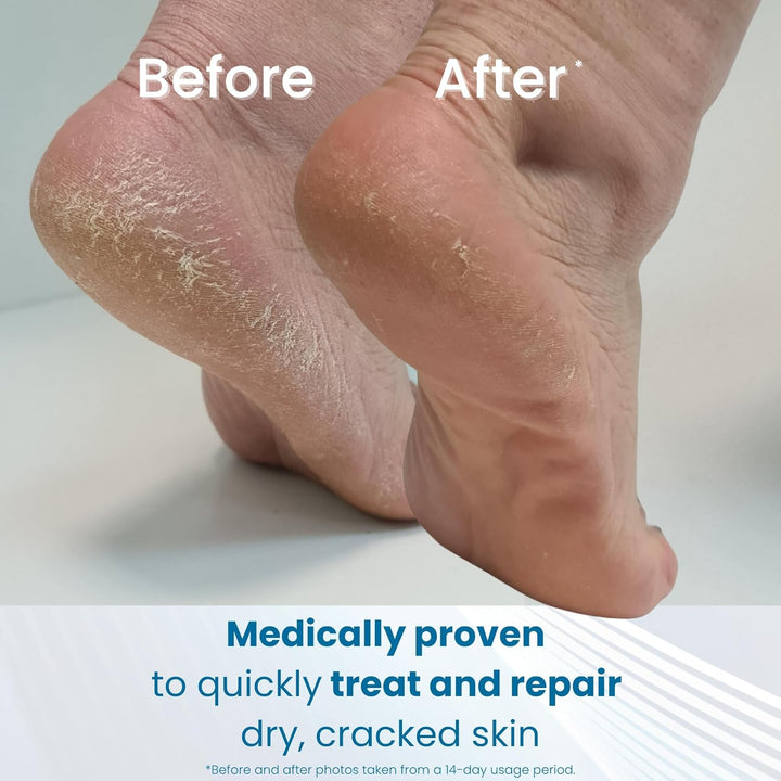 Cracked Heel Balm, Visible Results in 1 Day, for Extremely Dry Feet & Cracked Heels, Removes Hard Skin, 25% Urea, Medically Proven Foot Cream, Suitable for Diabetics, 1 X 56G