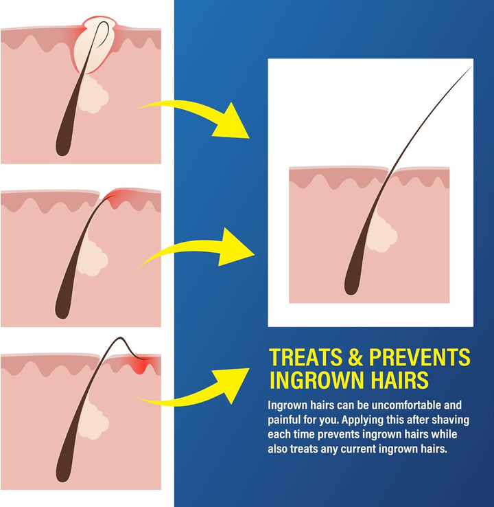 Razor Bump and Ingrown Hairs Serum - after Shave Solution Roll-On for Ingrown Hairs, Razor Burns and Razor Bumps for Men and Women