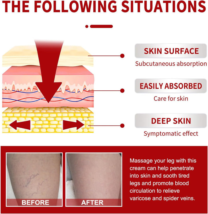 Cream for Varicose Veins in Legs,Varicose Veins Cream,Vein Relief Cream,Vein Cream for Legs,Varicose Veins Treatment Cream,Varicose Vein Removal Cream,Improve Blood Circulation,20G,1Pc