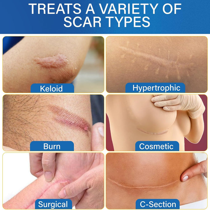 Silicone Scar Tape for Women- Reusable Medical-Grade Scar Strips for C-Section Surgery, Breast, Acne, and Keloid Scars - Invisible, Soft, Long Roll 4Cm X 150Cm