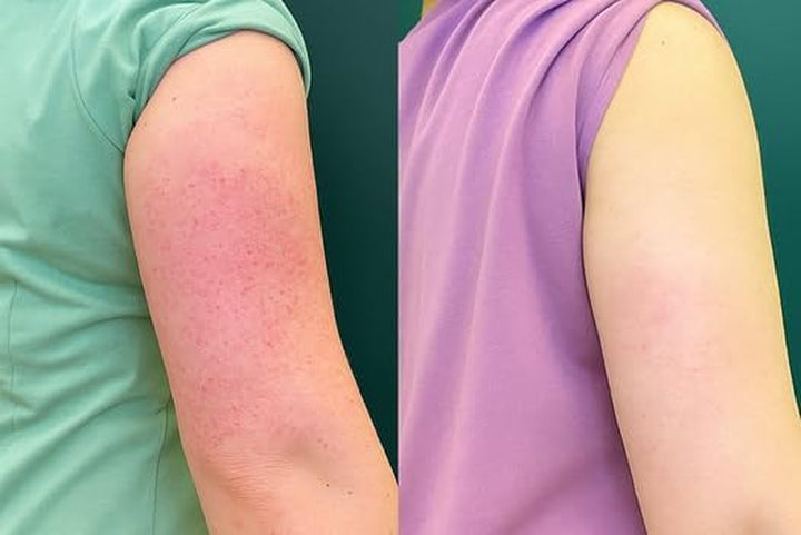 Keratosis Pilaris Spray Treatment for Strawberry Legs, Chicken Skin & Bumpy Arms – with 2% Salicylic Acid, Glycolic Acid, Glycerin & Panthenol