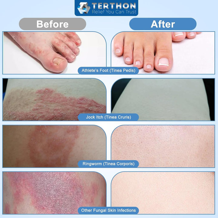 Herbal Antifungal Cream: Treatment for Ringworm, Jock Itch, Athlete’S Foot & Fungal Skin Infections – Natural, Fast-Acting Formula for Adults and Kids (20G (1 Pack))