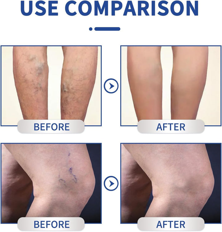 Leg Varicose Ointment,Varicose Vein Gel,Varicose Vein Removal Cream,Vein Relief Cream for Pain Relief, Natural Varicose,20G