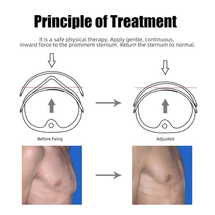 Pectus Carinatum Orthosis Brace, Pigeon Chest Orthosis Support, Adjustable Medical Chest Brace for Pectus Excavatum Ribs Valgus Orthosis Brace (For Adult)