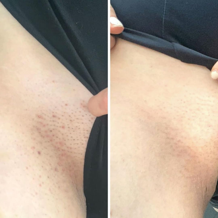 Healing Intimate Oil for down There | Ingrown Hairs, Razor Bumps after Shaving Bikini Line | Fragrance-Free Natural Itch Relief for Dry Skin | UK Made Vegan & Cruelty-Free Skincare | 30Ml