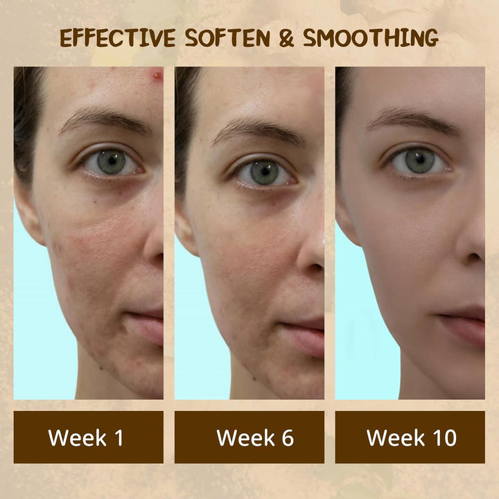 2PCS Turmeric Soap Bar, Natural Handmade Kojic Acid Soap for Face & Body, Dark Spot Acne Blackheads Remover for Even Skin Tone, Moisturizing Erase Fine Lines, Gentle Vitamins C Soaps with Foaming Nets