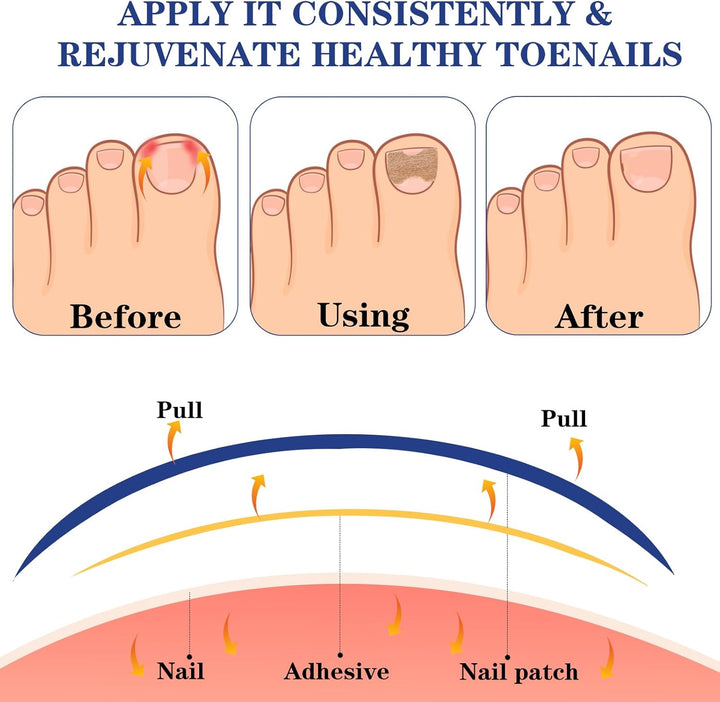 60Pcs Ingrown Toenail Treatment Patches, Toe Nail Correction Patches, Painless Hammer Toe Corrector, Durable Toe Spacers, Quick Repair Ingrown Nail Tool for Women Men