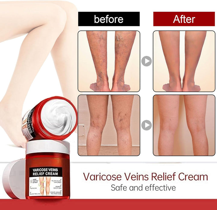 80G Varicose Veins Relief Cream, Varicose Veins Treatment for Legs, Varicose Veins Cream Vein Relief Cream Varicose Veins Treatment Cream for Legs Aching Legs Relief, Spider Veins Repair Cream
