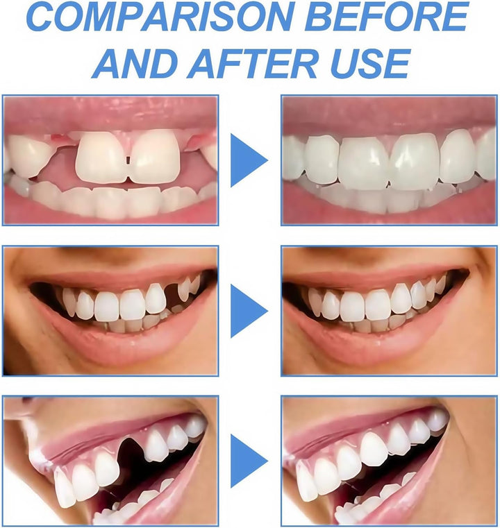 Temporary Tooth Filling Repair Kit,Denture False Teeth Repair Beads for Missing or Broken Tooth,Moldable False Teeth Replacement,Broken Tooth Repair Kit,Teeth Gap Filler,Friendly to User,Multiple Use