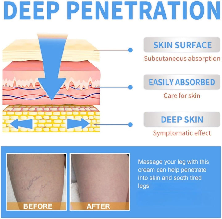 Varicos/E Ve/Ins Treatment for Legs,Varic/Ose Ve/Ins Treatment Cream,Sp/Ider Ve/Ins Repair Cream,Varicos/E Vein/S Cream,Spi/Der Vei/N Removal,Cre/Am for Varic/Ose V/Eins,Safe Formula,Portable