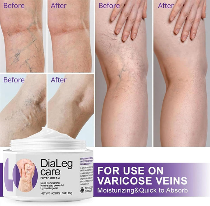 Dialeg Care Varicose Relief Veins Cream - Varicose Veins Treatment for Legs - V-Ein Cream Improve the Look of Legs - Natural Ourlyard C-Ream, Deep Penetrating, Hypo-Allergenic for All Skin